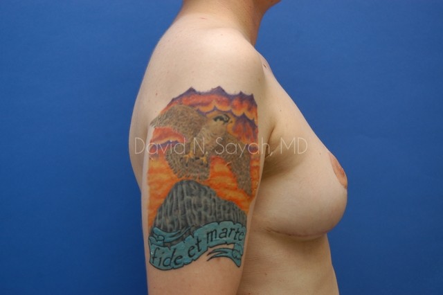 Breast Lift Before and After | Sayah Institute