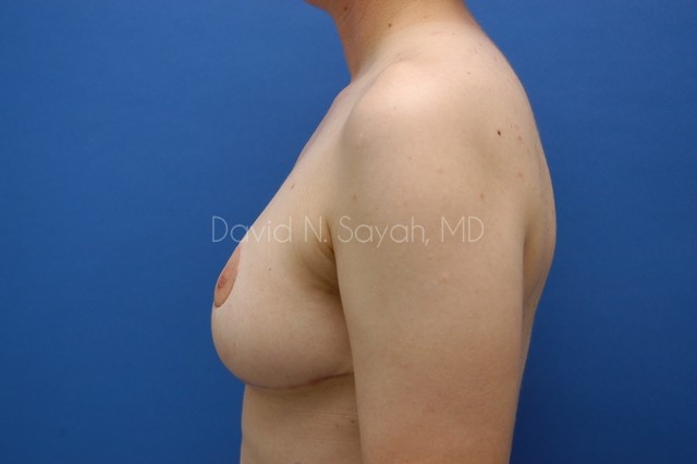 Breast Lift Before and After | Sayah Institute
