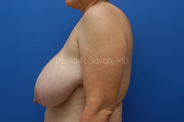 Breast Lift Before and After | Sayah Institute