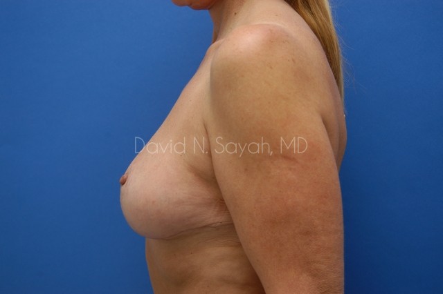 Breast Lift Before and After | Sayah Institute
