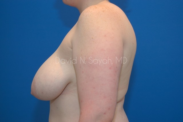 Breast Lift Before and After | Sayah Institute