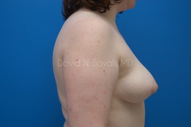 Breast Lift Before and After | Sayah Institute