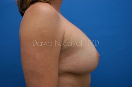 Breast Lift Before and After | Sayah Institute