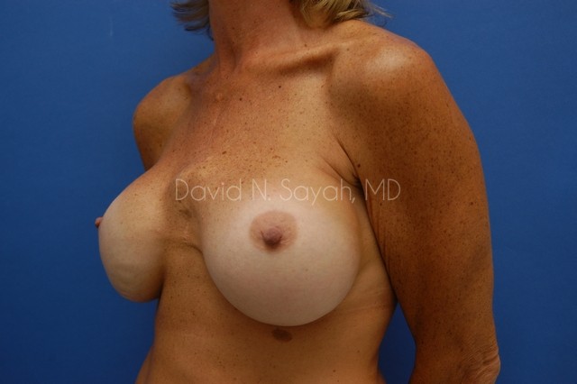 Breast Lift Before and After | Sayah Institute