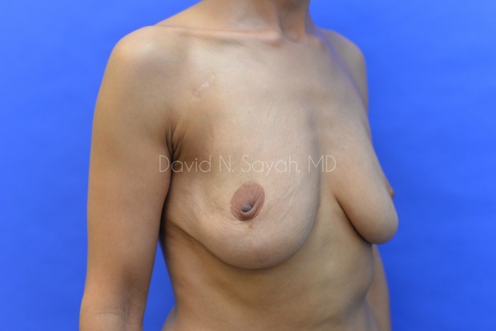 Breast Reconstruction Before and After | Sayah Institute