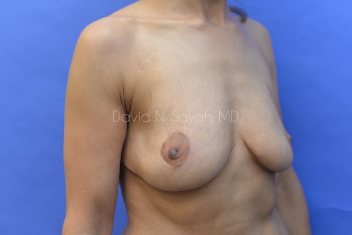 Breast Reconstruction Before and After | Sayah Institute