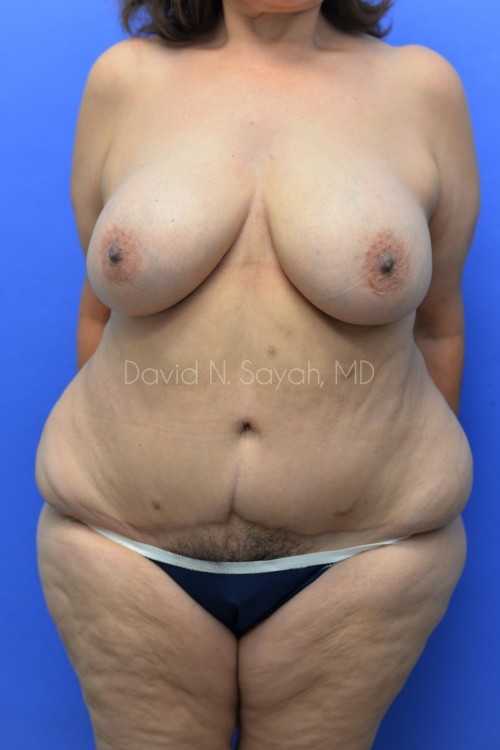 Breast Reconstruction Before and After | Sayah Institute