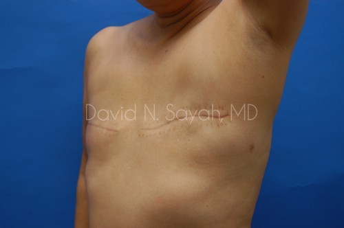 Breast Reconstruction Before and After | Sayah Institute