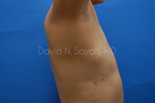 Breast Reconstruction Before and After | Sayah Institute