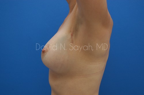 Breast Reconstruction Before and After | Sayah Institute