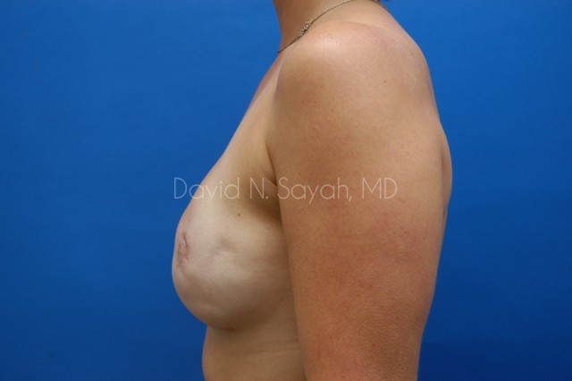 Breast Reconstruction Before and After | Sayah Institute