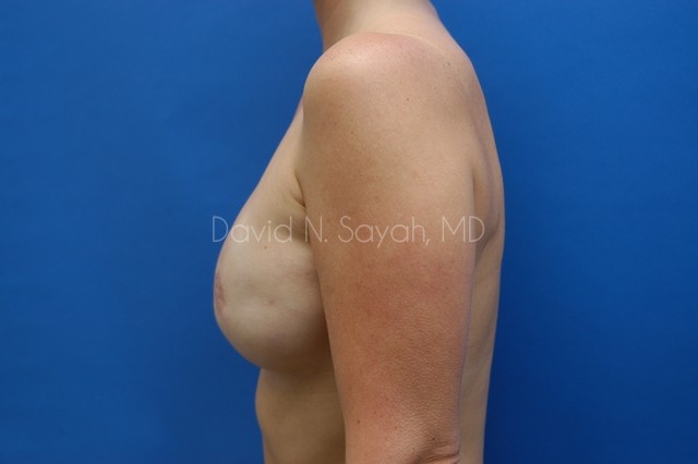 Breast Reconstruction Before and After | Sayah Institute