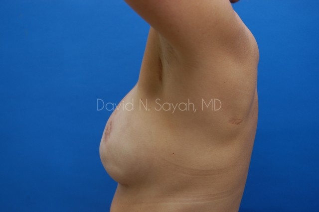Breast Reconstruction Before and After | Sayah Institute