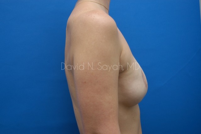 Breast Reconstruction Before and After | Sayah Institute