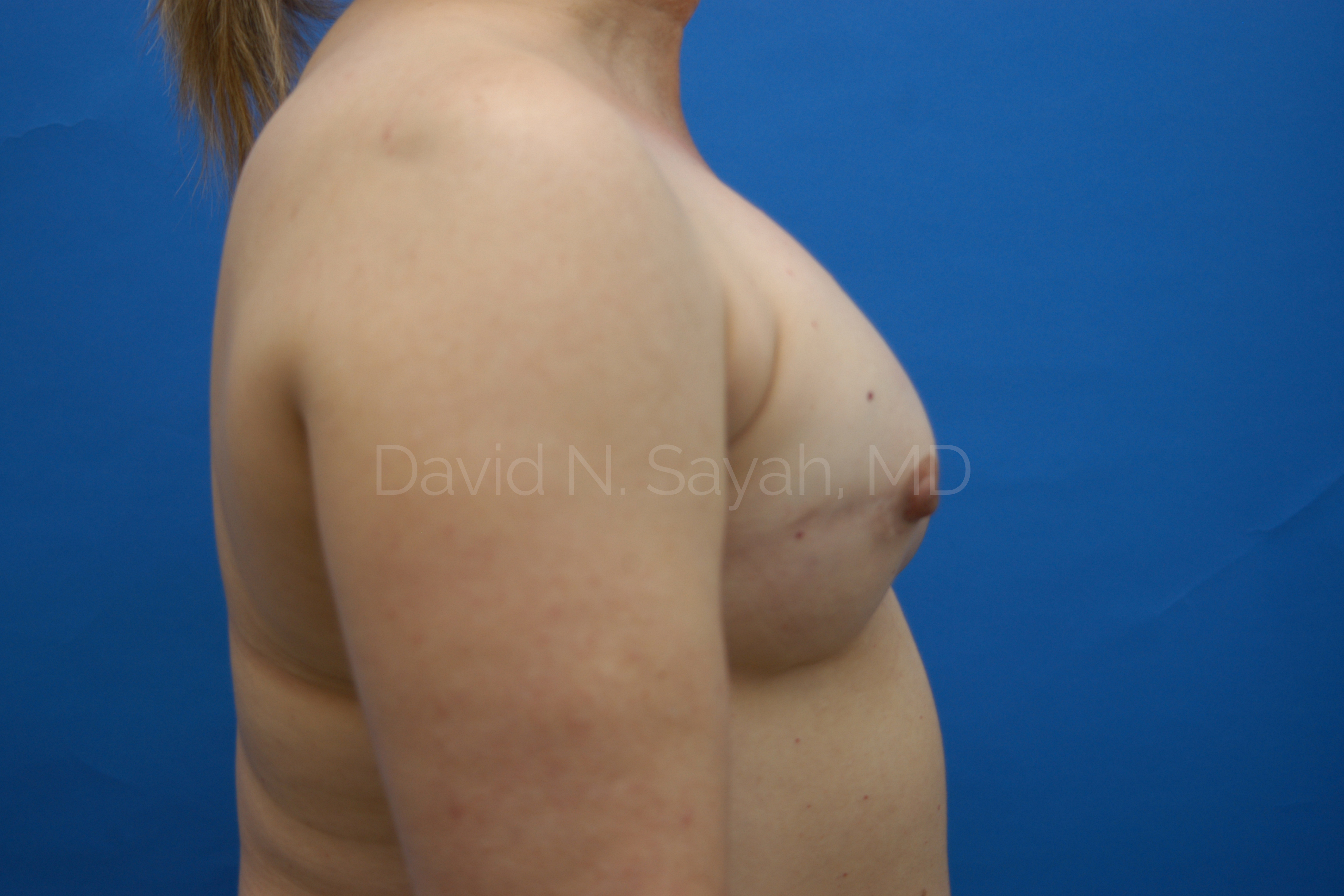 Breast Reconstruction Before and After | Sayah Institute