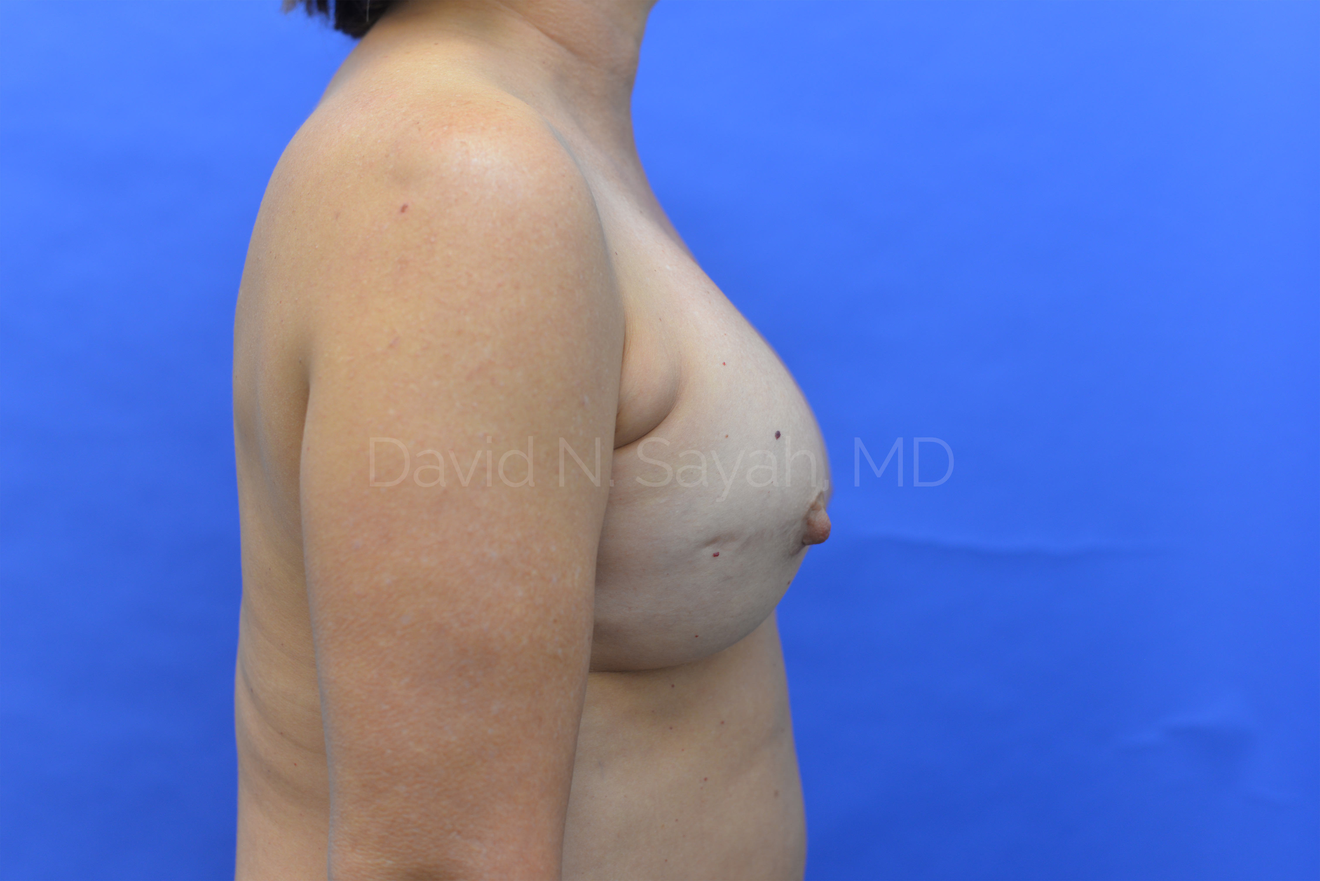 Breast Reconstruction Before and After | Sayah Institute