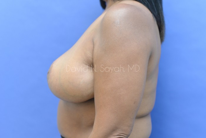 Breast Reduction Before and After | Sayah Institute