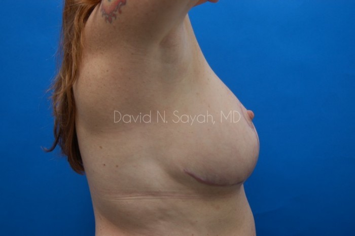 Breast Reduction Before and After | Sayah Institute