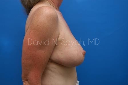 Breast Reduction Before and After | Sayah Institute