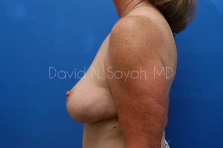 Breast Reduction Before and After | Sayah Institute