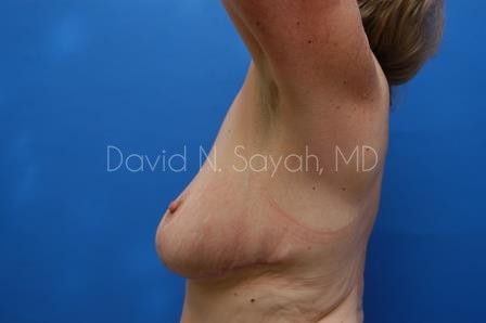 Breast Reduction Before and After | Sayah Institute