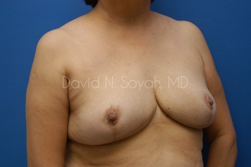 Breast Reduction Before and After | Sayah Institute