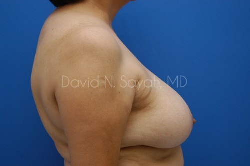 Breast Reduction Before and After | Sayah Institute
