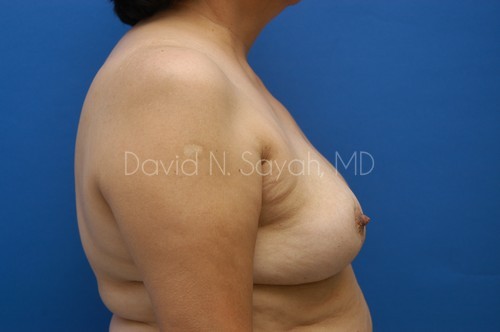Breast Reduction Before and After | Sayah Institute