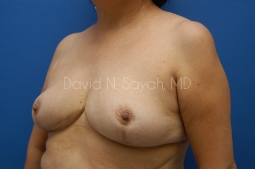 Breast Reduction Before and After | Sayah Institute