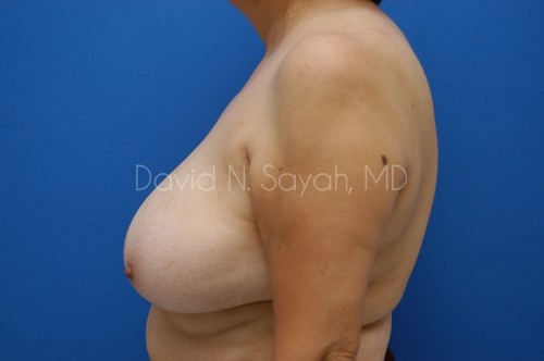 Breast Reduction Before and After | Sayah Institute