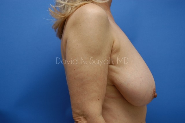Breast Reduction Before and After | Sayah Institute