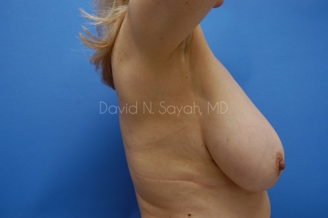Breast Reduction Before and After | Sayah Institute