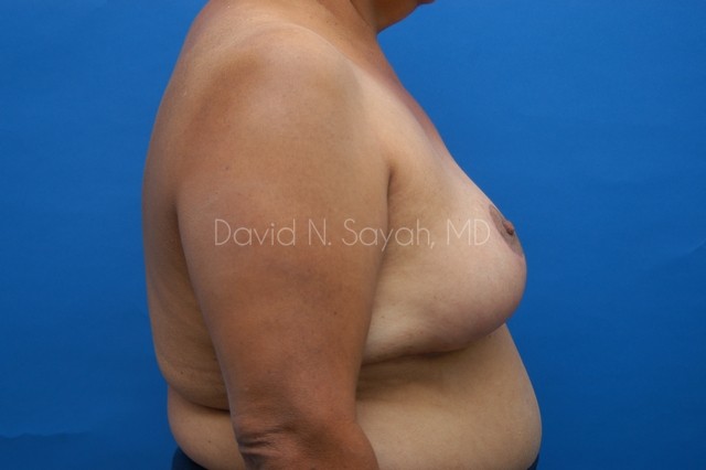 Breast Reduction Before and After | Sayah Institute