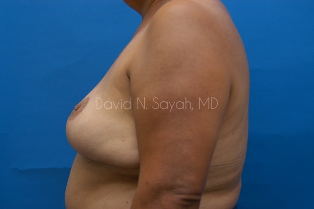 Breast Reduction Before and After | Sayah Institute