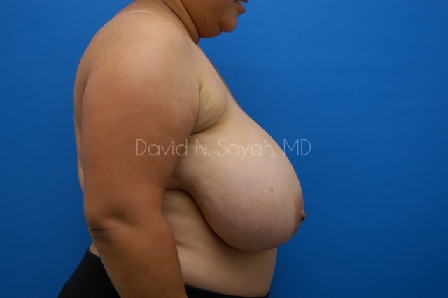 Breast Reduction Before and After | Sayah Institute