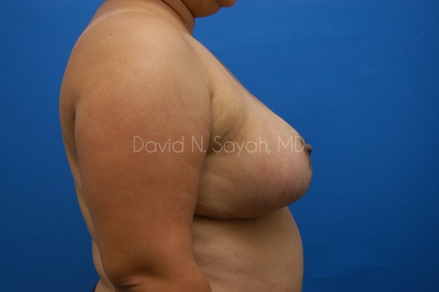 Breast Reduction Before and After | Sayah Institute