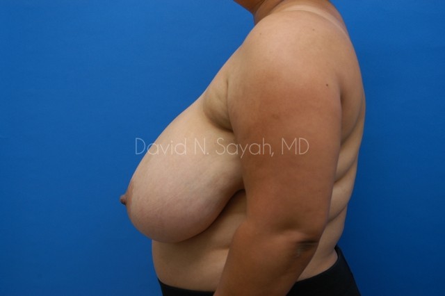 Breast Reduction Before and After | Sayah Institute