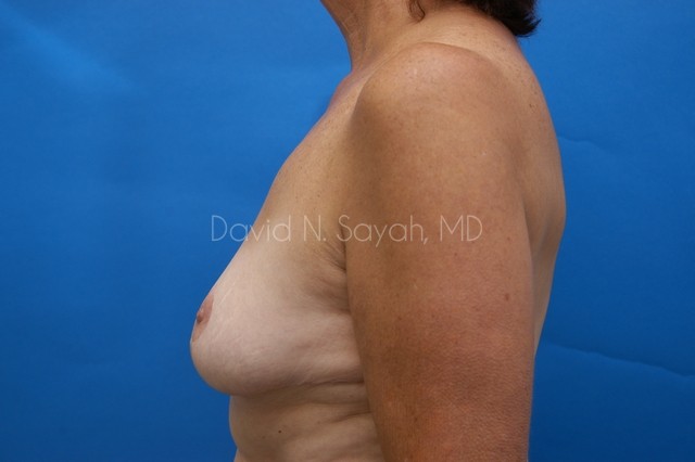 Breast Reduction Before and After | Sayah Institute