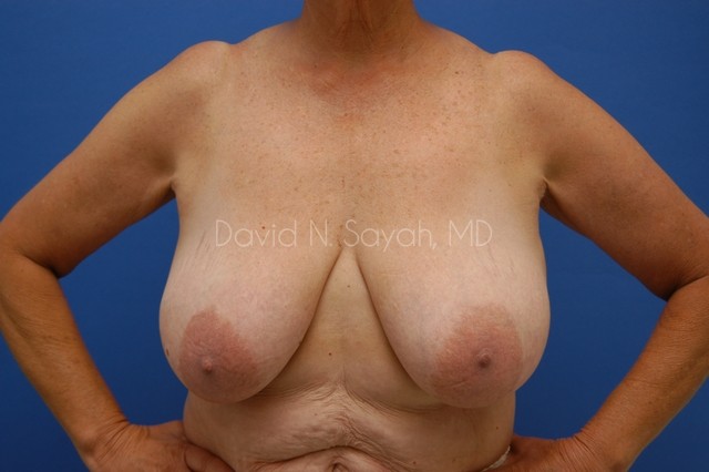 Breast Reduction Before and After | Sayah Institute