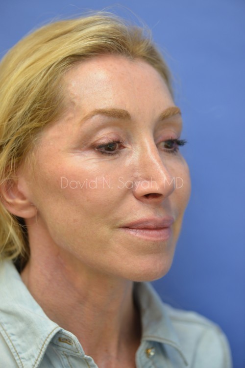 Brow Lift Before and After | Sayah Institute