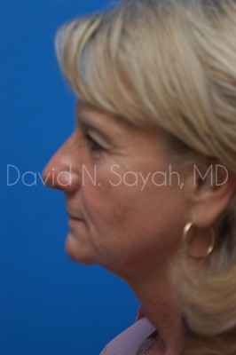 Brow Lift Before and After | Sayah Institute