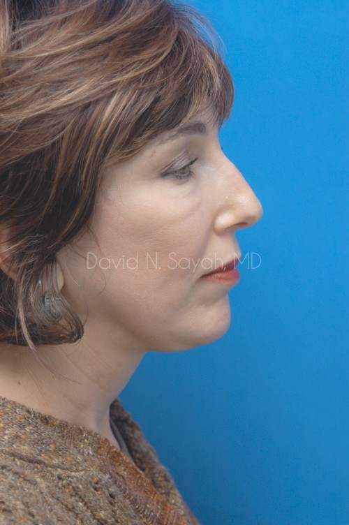 Brow Lift Before and After | Sayah Institute