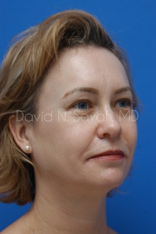 Brow Lift Before and After | Sayah Institute