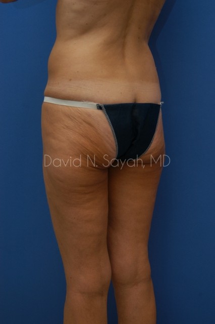 Buttock Lift Before and After | Sayah Institute