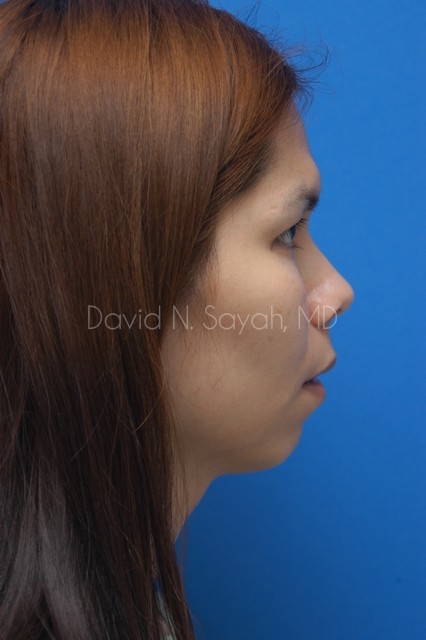Chin Implant Before and After | Sayah Institute
