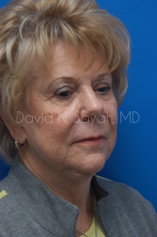 Chin Implant Before and After | Sayah Institute