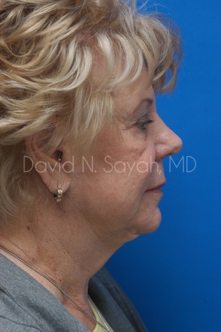 Chin Implant Before and After | Sayah Institute
