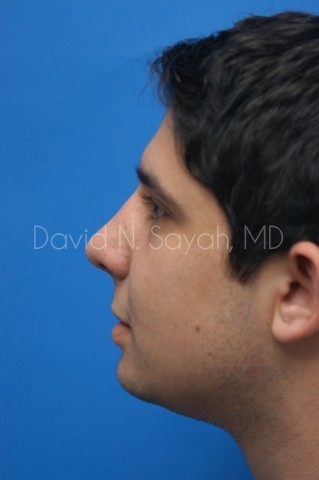 Chin Implant Before and After | Sayah Institute