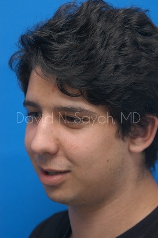 Chin Implant Before and After | Sayah Institute