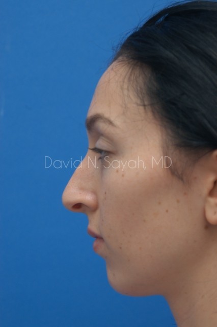 Chin Implant Before and After | Sayah Institute